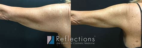 velashape sacramento|Velashape Sacramento .